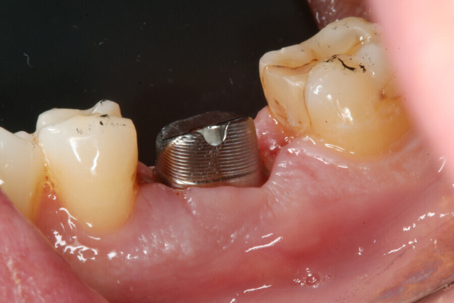 Fig. 13: Abutment in place.