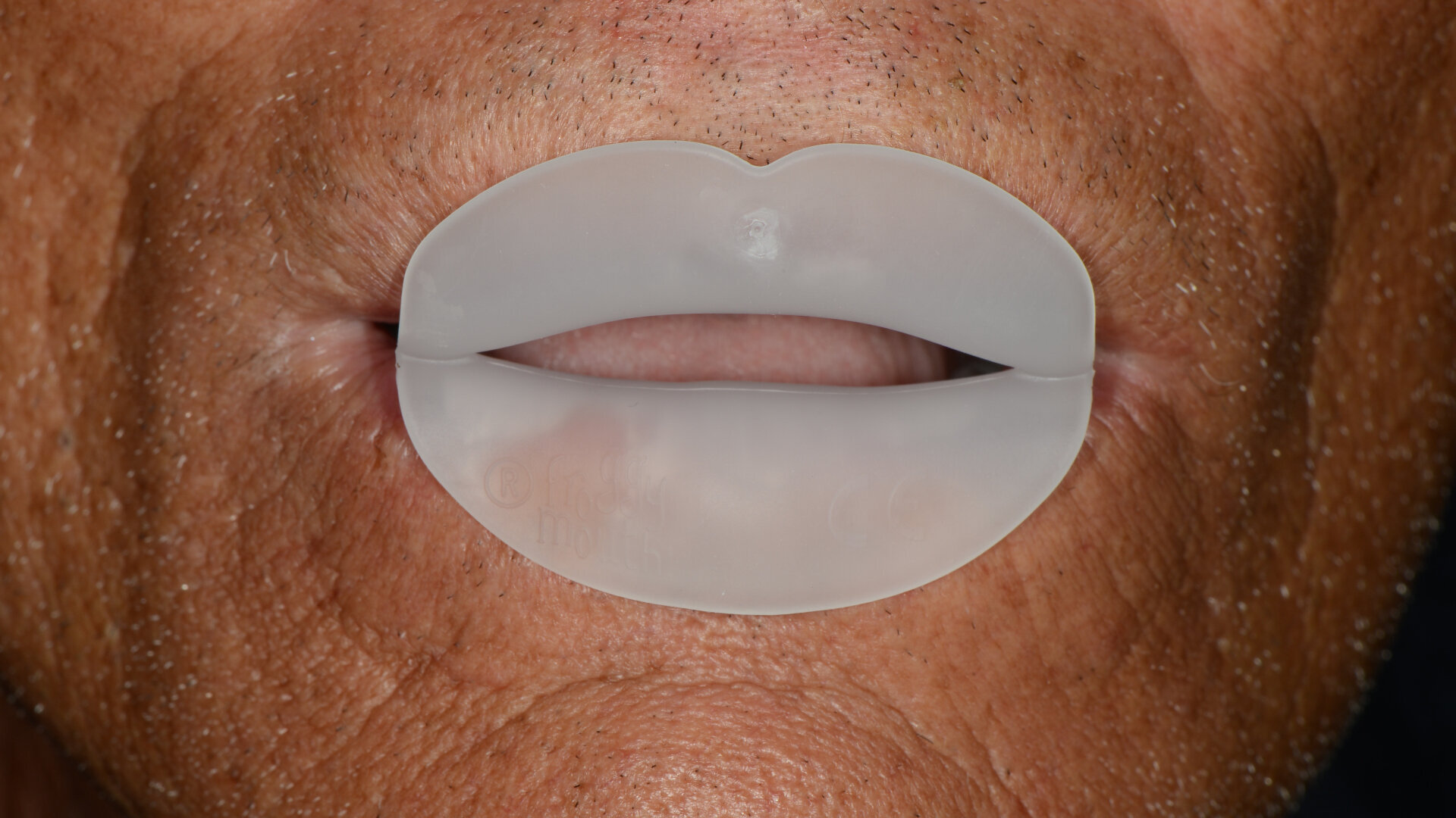 Interdisciplinary rehabilitation involving Froggymouth