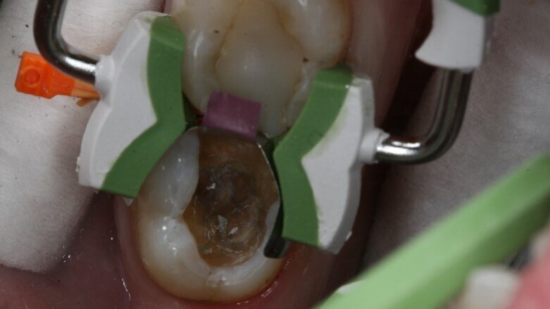 Garrison Dental Composi-Tight 3D Fusion System