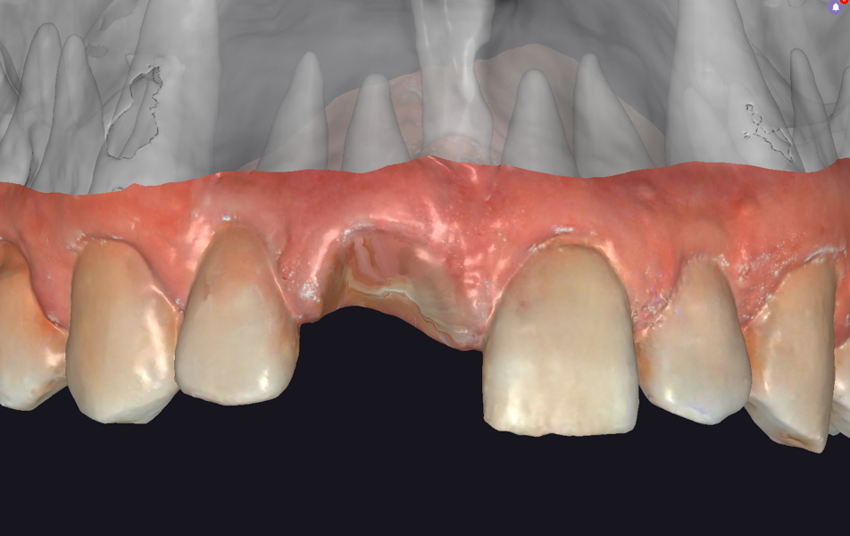 Fig. 6: Intra-oral image of the crowns and roots adjacent to the extraction site in exoplan, anterior view.
