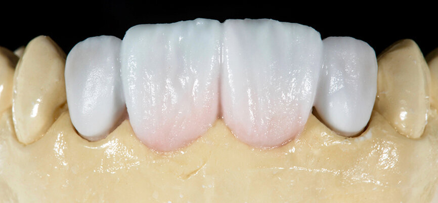 Fig. 11. Se reprodujo el esmalte mediante una mezcla de ENAMEL 1 (70%) y TRANSLUCENT 4 (30%).