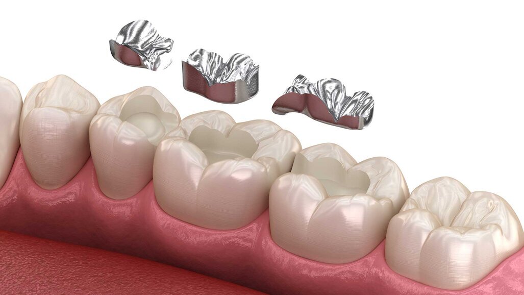 Keine Lösung in Sicht: Verhandlungen über Amalgam-Ersatz abgebrochen