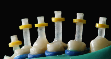 Acondicionamiento del canal radicular para colocar un perno de fibra de vidrio