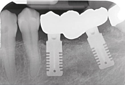 Fig. 16 - RX di accoppiamento.