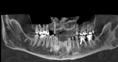 Występowanie dwudzielnego kanału żuchwy – przegląd piśmiennictwa