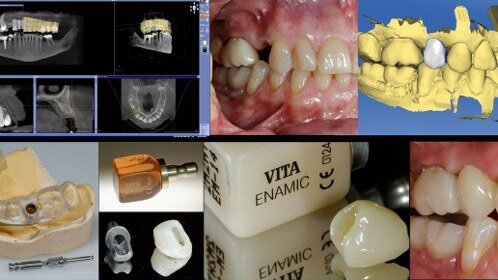 Experte beleuchtet Aufwand und Nutzen der integrierten Implantologie