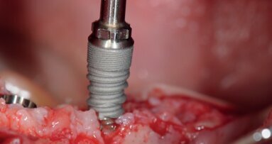 The clinical effects of insertion torque for implants placed in healed ridges: A two-year randomized controlled clinical trial