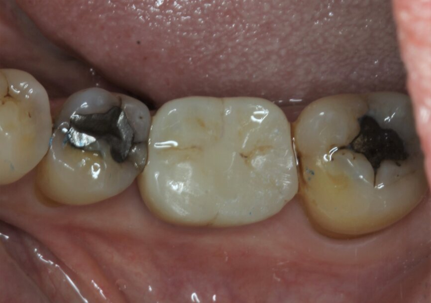 Fig. 20: Temporary crown immediately seated.