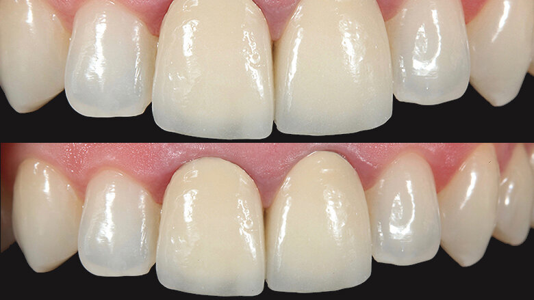 Caso clínico: Precisión del color con una nueva cerámica