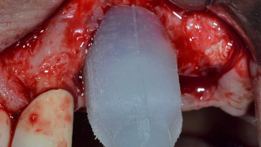 Fig. 7 - Posizionamento di una membrana barriera di tipo riassorbibile.