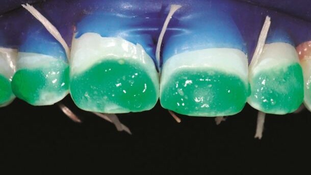 Infiltratie van fluorosevlekken ter bevordering van weefselconservering