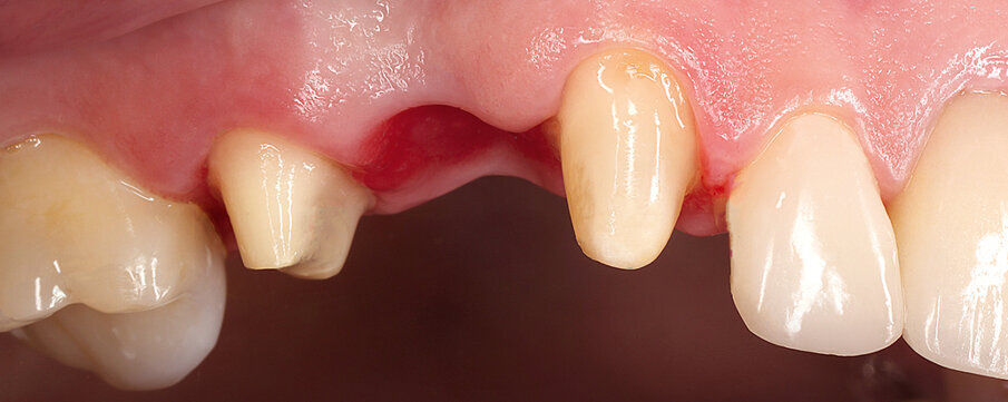 Fig. 27: Preparation for a three-unit bridge with an ovate pontic design