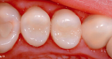 The renaissance of a classic: Tetric-N Ceram—a perfect combination of experience and innovation