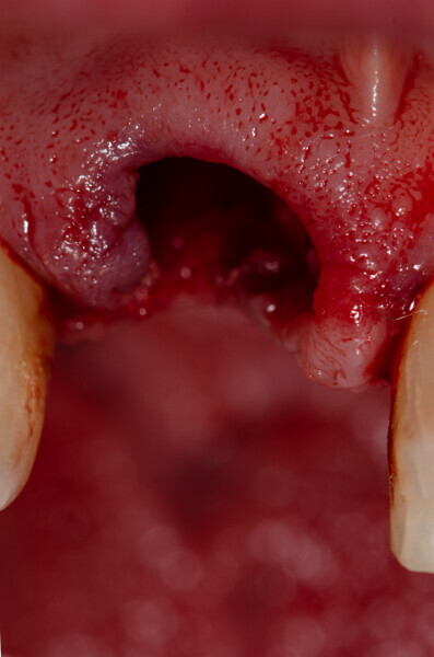 Fig. 15a: Situation after implant placement, anterior view.