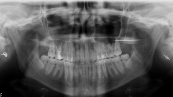 Irrigation for the root canal and nothing but the root canal