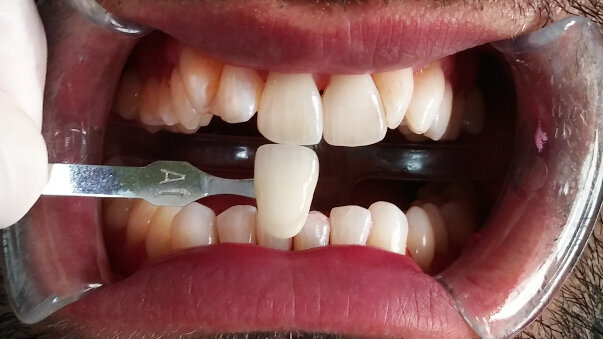 Le blanchiment après nettoyage devient un traitement pour tous