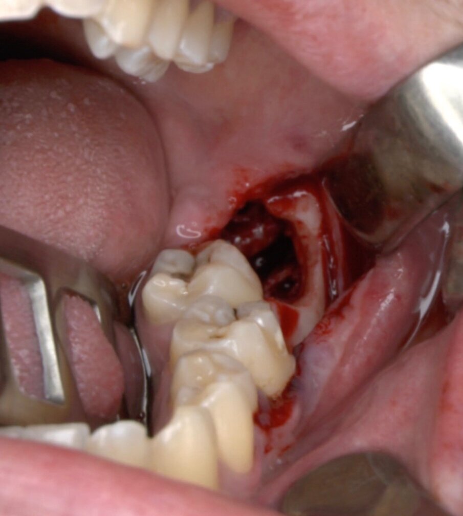 Fig. 10_Cavità alveolare residua.
