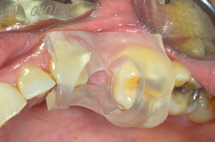 Fig. 10b_La dima prima dell’atto chirurgico.