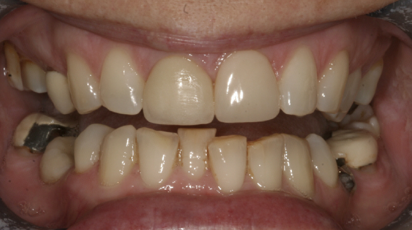 Fig. 1: 2004—discoloured maxillary central incisors.