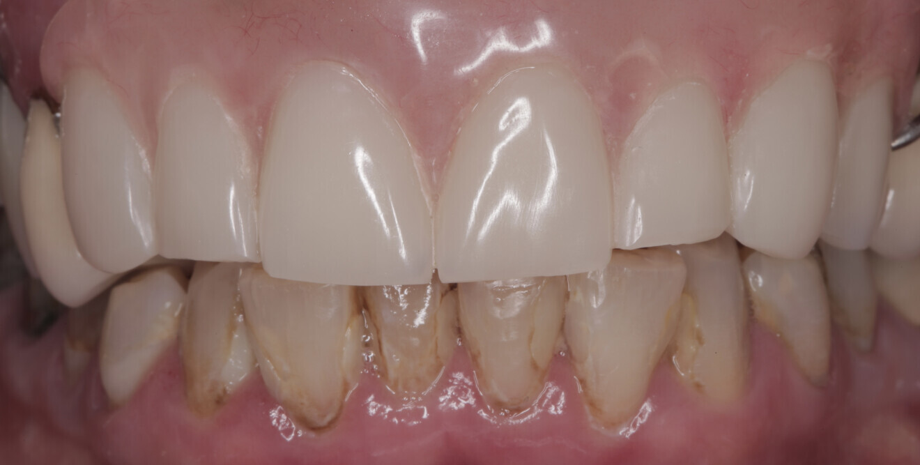 Fig. 2b: Frontal view of the initial presentation with the partial acrylic denture.