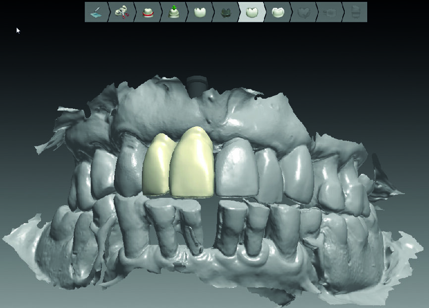 Fig. 13 : Réalisation des couronnes définitives grâce au logiciel de design.