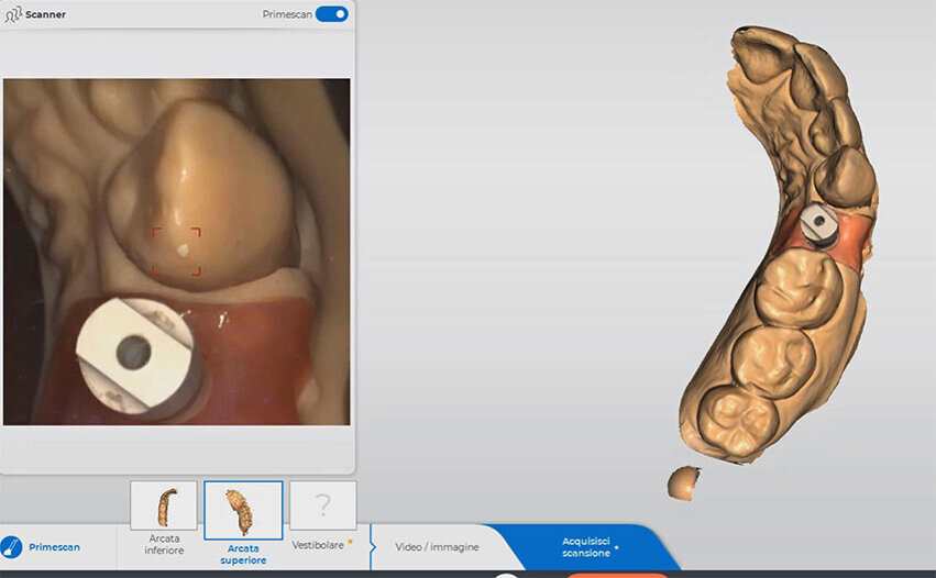 Fig. 14_L’impronta intraoperatoria con scanner intraorale Dentsply Sirona Primescan.