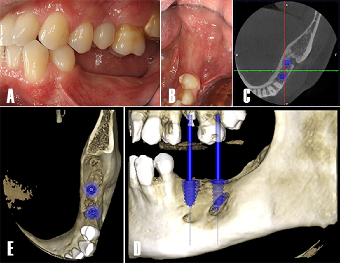 Figura 11. PlanificaciÃ³n de implantes. EvaluaciÃ³n intraoral de la zona tratada. A) Se evalÃºa las necesidades protÃ©sicas y calidad de los tejidos blandos. B) En un vista oclusal, se observa los tejidos blandos saludables y presencia de mucosa queratinizada. C) Se realiza una TCHC y se planifica la colocaciÃ³n de dos implantes dentales en posiciÃ³n 3.5 y 3.7.
