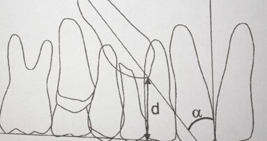 Trattamento intercettivo dell’inclusione del canino: perché aspettare?