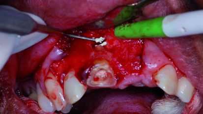 Use of mineral trioxide aggregate in endodontic retro-filling