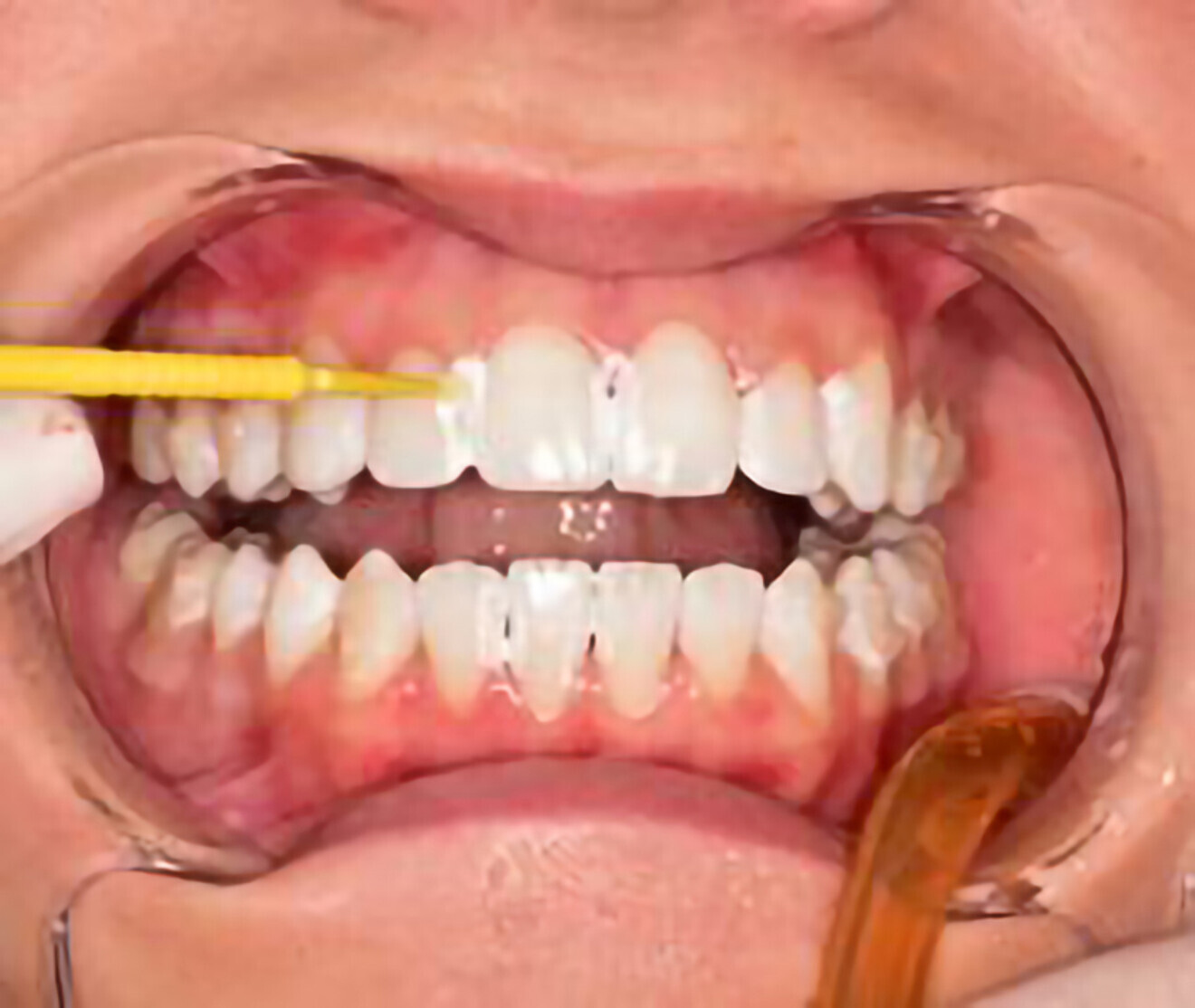 Fig. 14: Applying varnish to IPR-treated contacts.