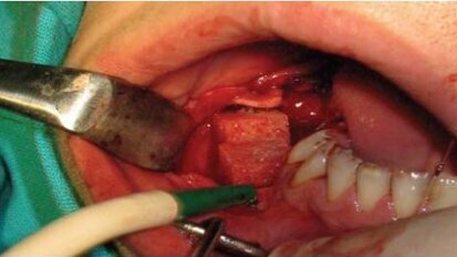 Metody augmentacji z wykorzystaniem czynników wzrostowych i komórek macierzystych