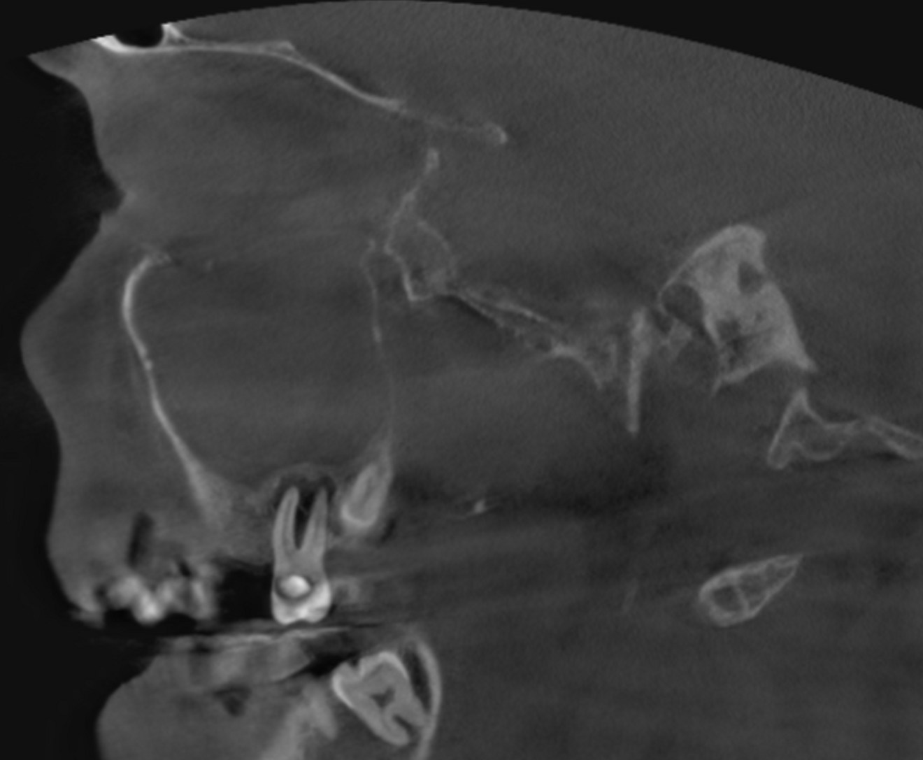 Fig. 2a: Large-volume CBCT scan, sagittal cross-section of the buccal roots.
