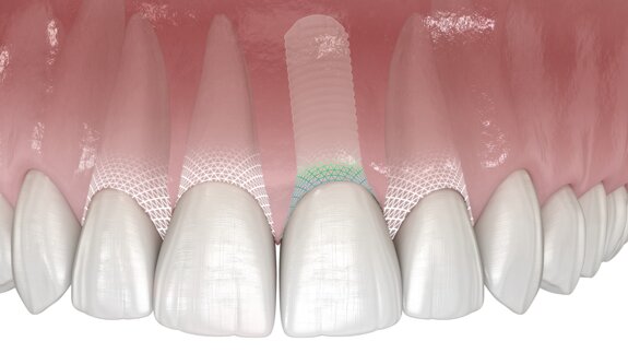 Symbionic Teeth : le remplacement dentaire avec barrière protectrice muqueuse