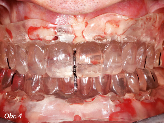 Protetické šablony byly použity ke kontrole okluze a zajištění reprodukovatelnosti.