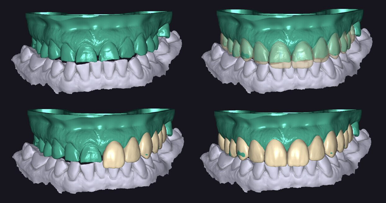 Fig. 3: Different views of the digital wax-up using scanned models in exocad.