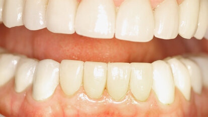 Esthetics, prosthetics, periodontics, implants and bisphosphonates