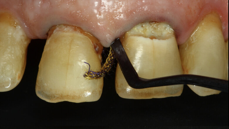 Figuras 2 y 3. Se colocan dos hilos retractores 000 y 00 Ultrapack y aislamiento absoluto con hilo dental tipo teflón y un clamp para dientes anteriores debido a que la lesión se extiende infra-gingivalmente.