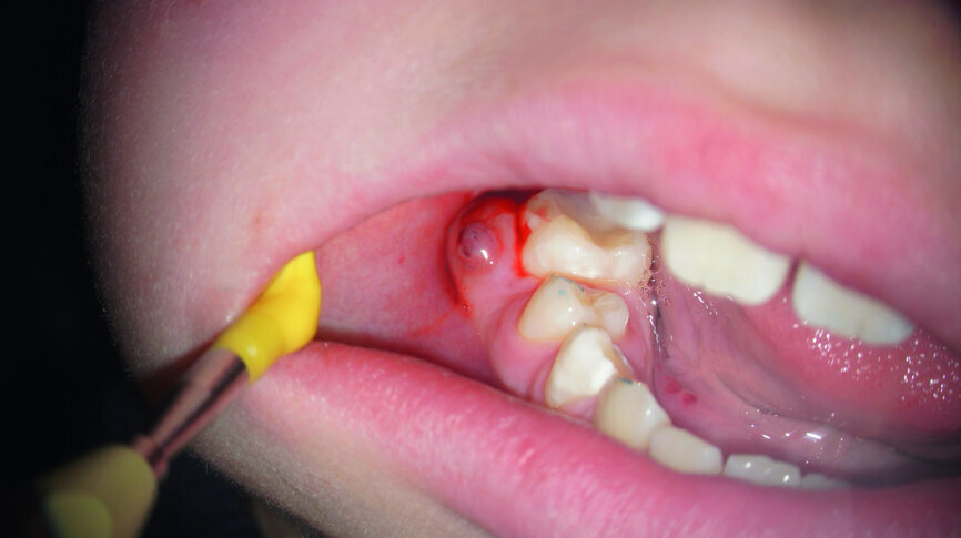 Fig. 4: Clinical image of tooth #46 showing swelling of the buccal mucosa and the presence of a sinus tract, as well as bleeding and pus after probing.
