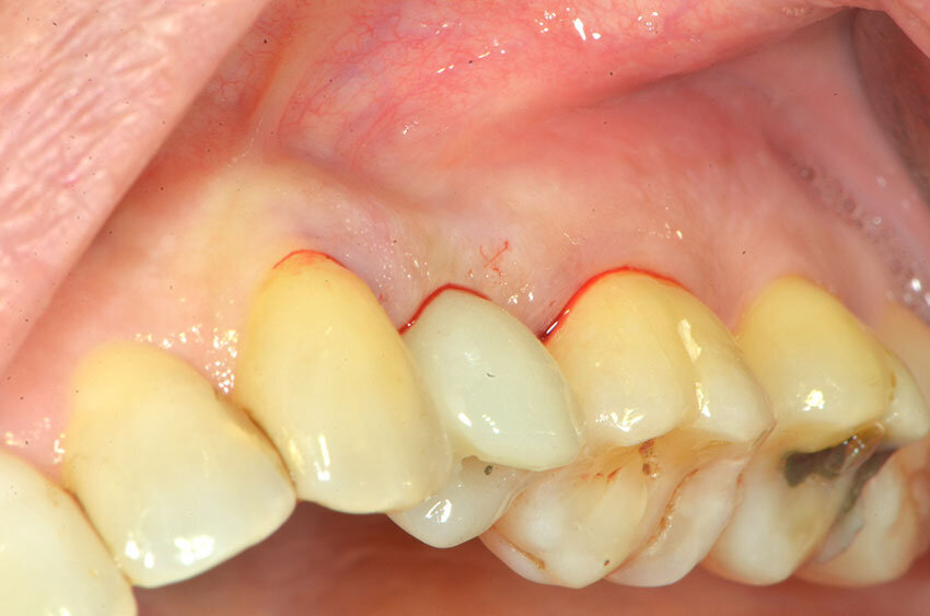 Fig. 18_Il provvisorio serrato in bocca.