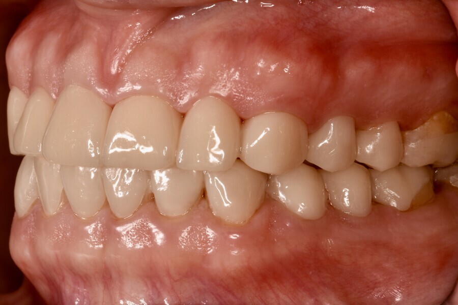 Fig. 11b: Temporarily cemented long-term provisional restorations. Left lateral view.
