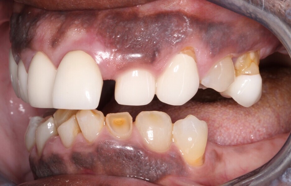 Fig. 7: Left lateral view showing multiple aesthetic and functional deficits.