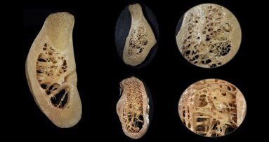 Piezocirugía  (3). La importancia de la biología ósea en la cirugía piezoeléctrica