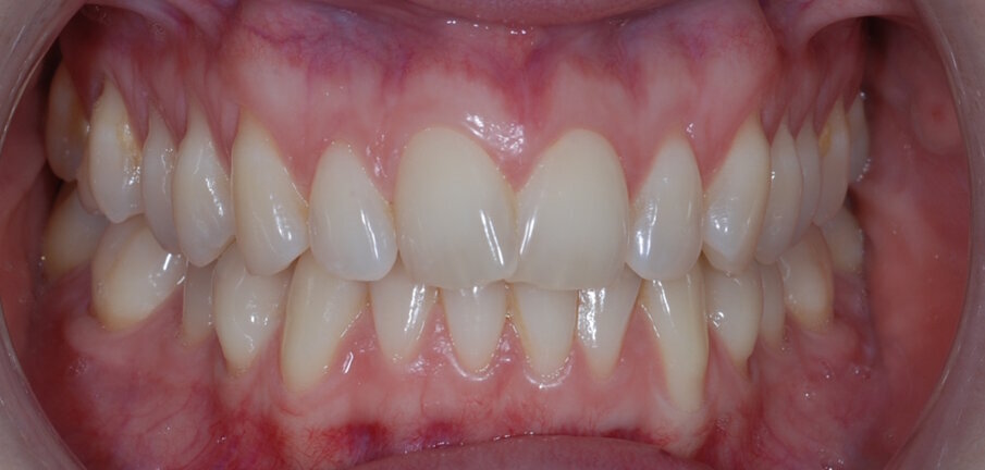 Fig. 5: Pre tretament retracted right lateral