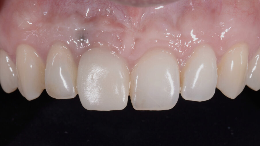 Fig. 28_Guarigione dopo 4 mesi.