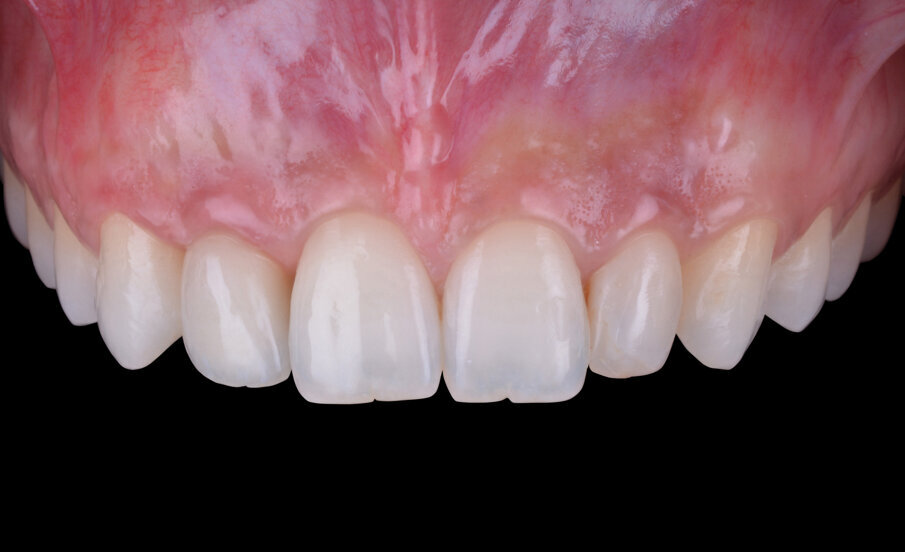 Fig. 16 - Caso clinico ultimato.