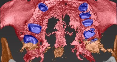 Piano di trattamento clinico con utilizzo di progetto digitale complesso su edentulie estese di entrambe le arcate dentarie