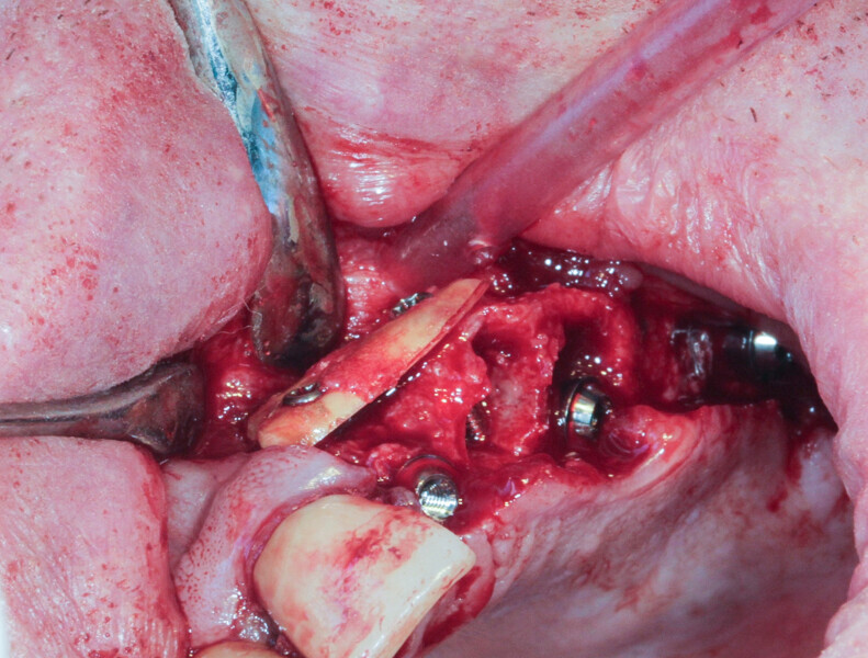 Fig. 12: Edges of the radicular graft in contact with the alveolar bone.