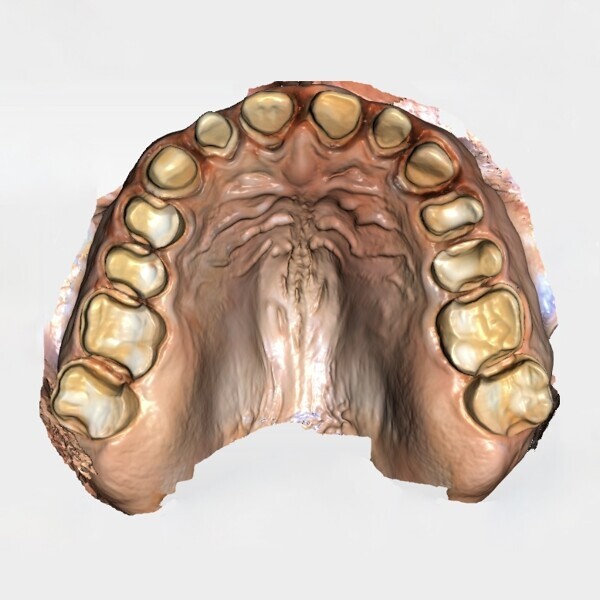 Fig. 7a: Digital scan of the prepared maxillary teeth. 