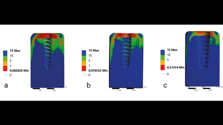 Fig. 10_Von Mises stress per 3 impianti con diametro crescente (a, b, c).