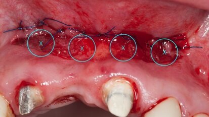 Biomodulacja laserem Nd:YAG z użyciem głowicy Genova®